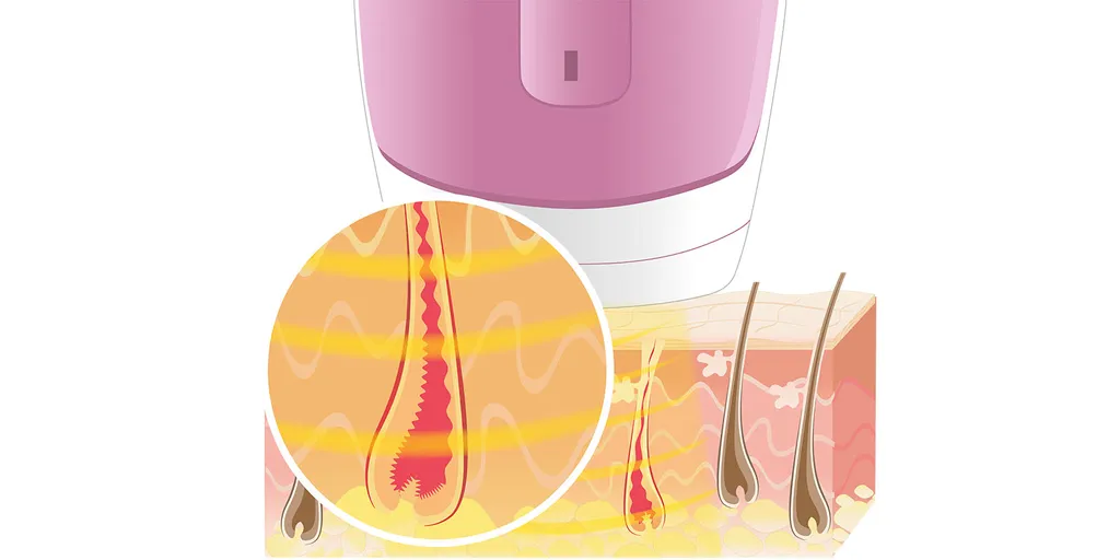 Sanitas Haarentfernungsgerät IPL 100 Epilierer Haarentferner 4 Sanitas Haarentfernungsgerät IPL 100 Epilierer Haarentferner – Bild 2